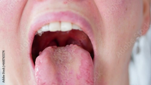 Enlarged papillae at the root of the tongue, glossitis, bacterial inflammation of the oral cavity. photo