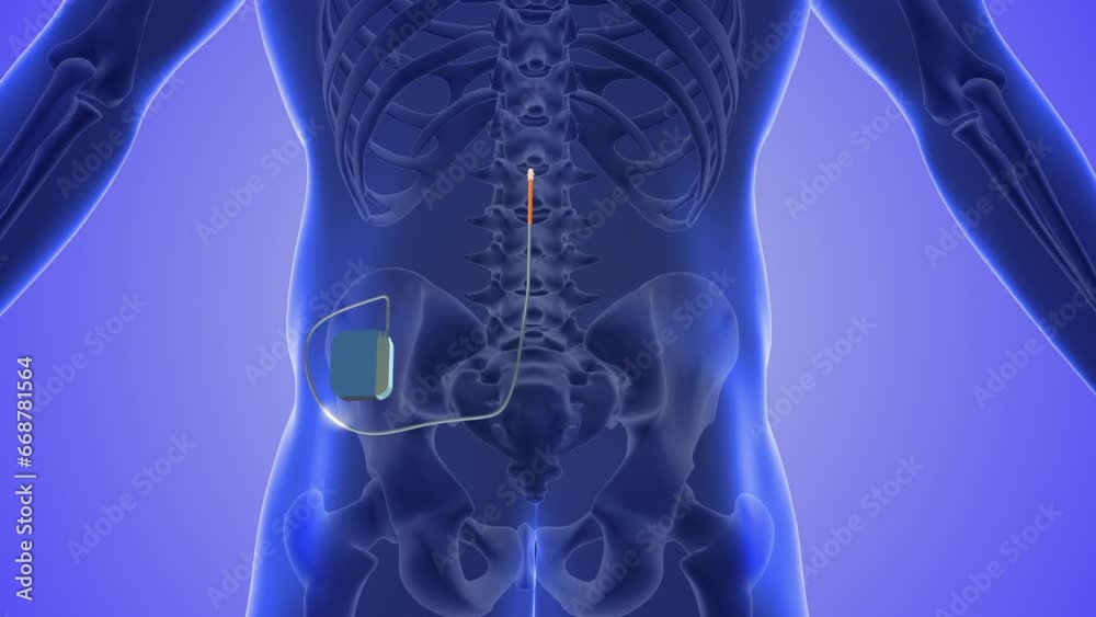 Spinal cord stimulation medical concept 