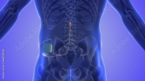 Spinal cord stimulation medical concept 