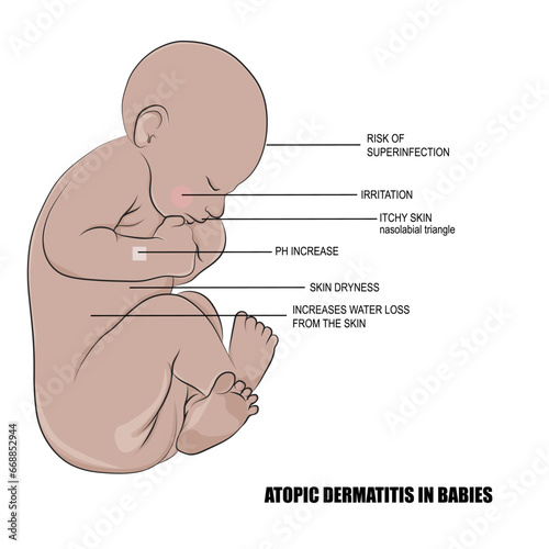 Atopic dermatitis is a long-term skin disorder that usually appears in the early years of childhood. photo