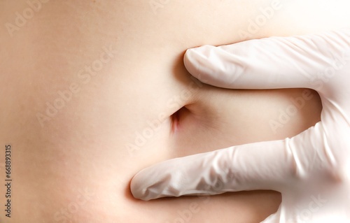Doctor with white gloves pointing at caucasian woman\'s abdomen scar from laparoscopic surgery on navel. Recent scar, scar healing well. Dermatology, surgery.