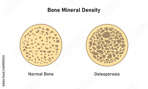 Osteoporosis (BMD) Concept Design. Vector Illustration.	