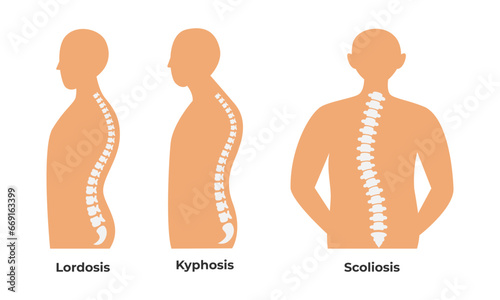 Types of Spinal Disorders Vector Set