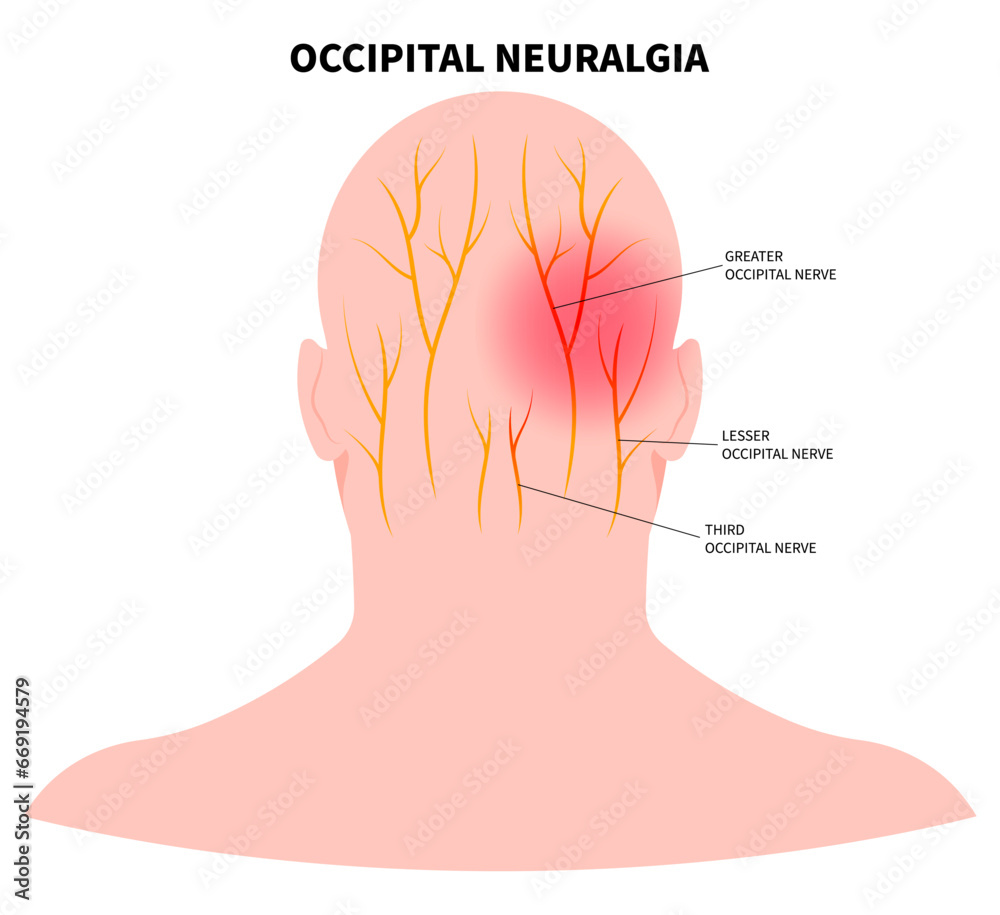 Headache with the occipital neuralgia nerve pain that cause migraine