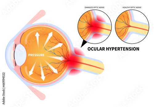 Eye pain anatomy with blurry vision and Ocular hypertension the examination for optic nerve cancer injury bleeding