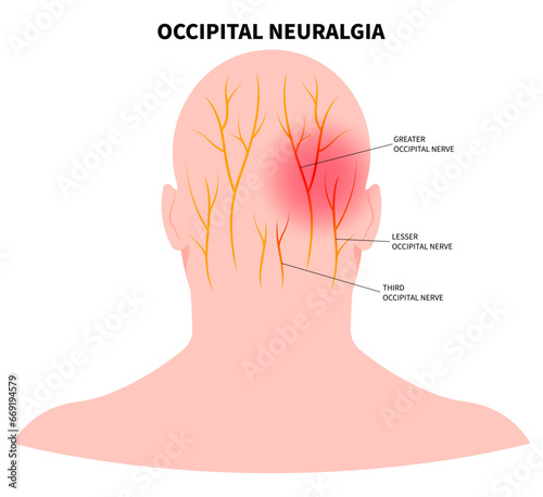 Headache with the occipital neuralgia nerve pain that cause migraine photo
