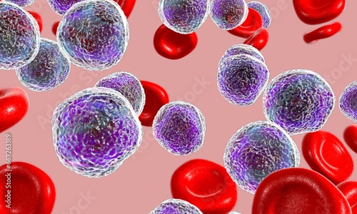 Bild auf Leinwand Acute lymphoblastic leukemia illustration on light pink background
