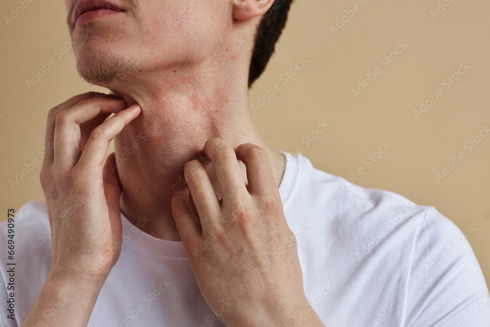Close up of young man scratching neck suffering from itch and allergies, copy space