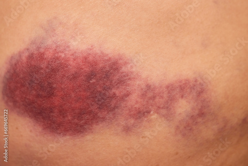 Accidents and wounds caused by impact. Purple skin bruises and abrasions.
