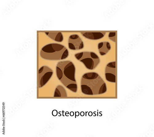 Osteoporosis, bone disease. Close-up of bone marrow density (BMD). Aging process. Medical concept. Vector illustration.