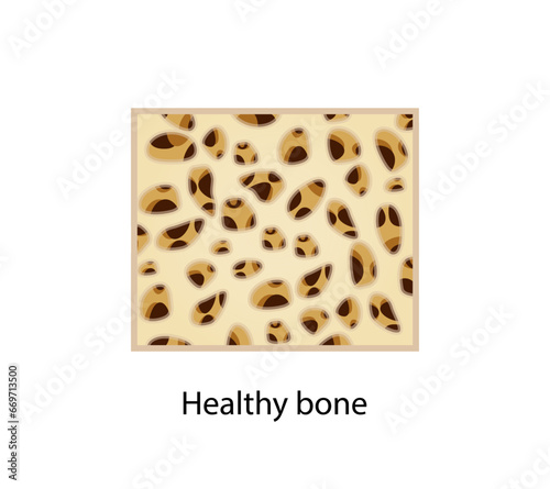 Healthy bone. Close-up of bone marrow density (BMD). Aging process. Osteoporosis, bone disease. Medical concept. Vector illustration.