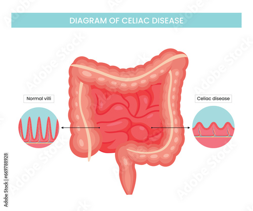 Structural diagram of celiac disease photo