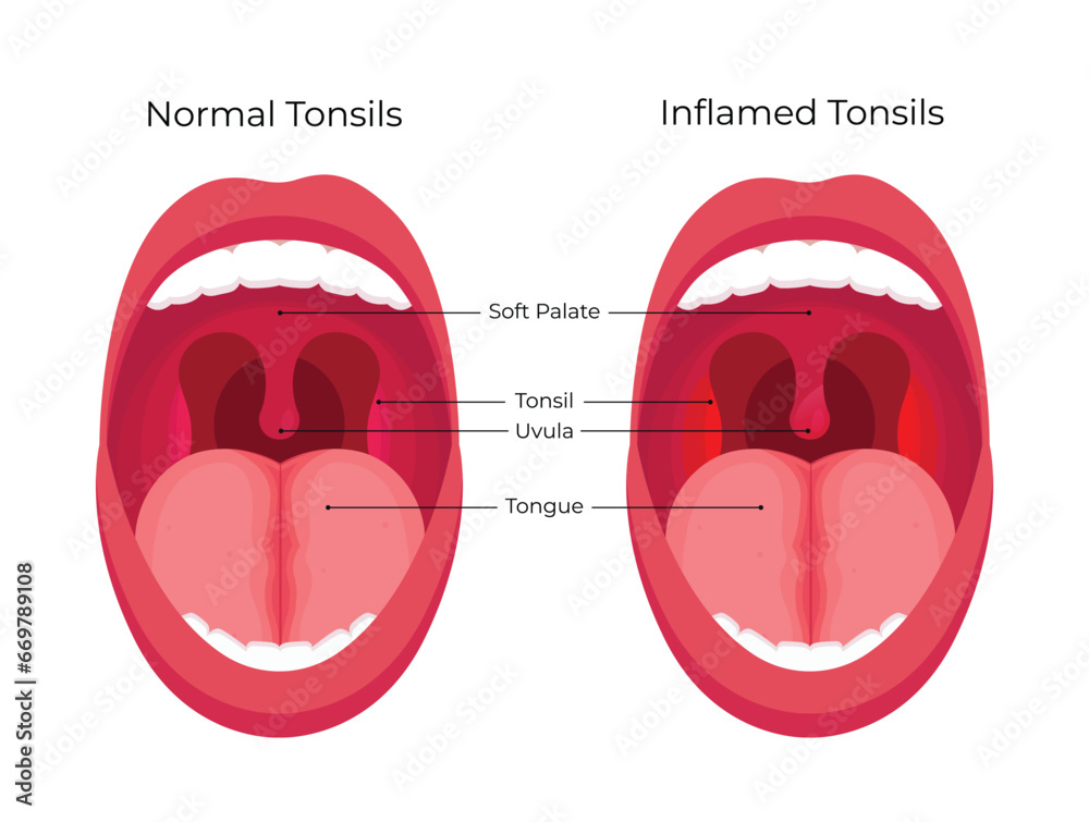 Comparison of normal human tonsils and inflamed tonsils Stock