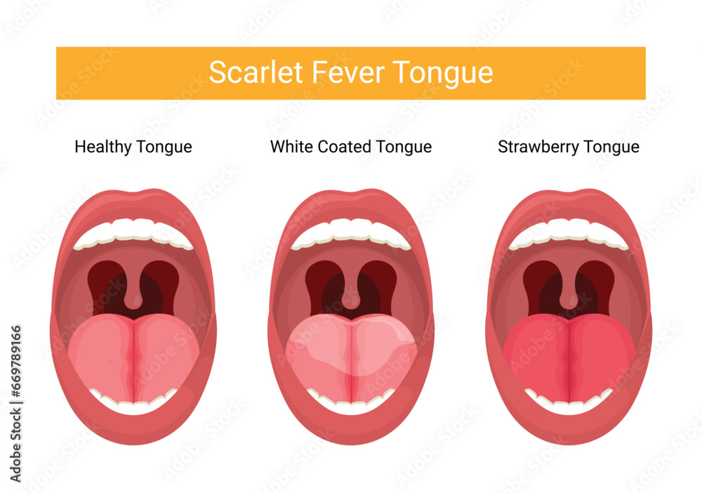Illustration of dengue fever tongue stage - obrazy, fototapety, plakaty 