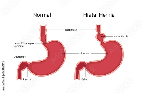 Normal human stomach compared to hiatal hernia