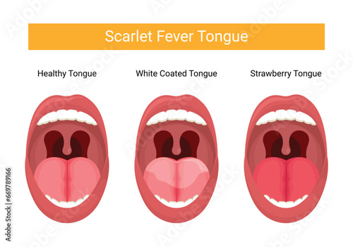 Illustration of dengue fever tongue stage