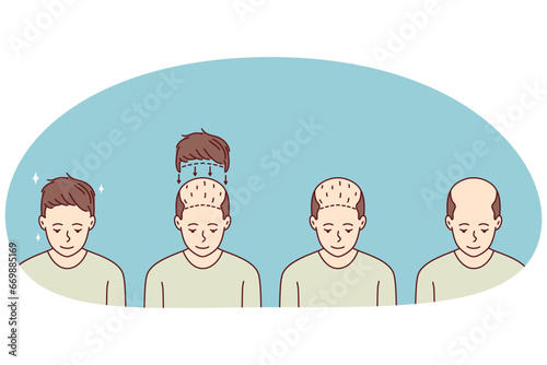 Stages on man hair transplant. Treatment of baldness and alopecia. Set of male patient follicular unit extraction. Vector illustration.