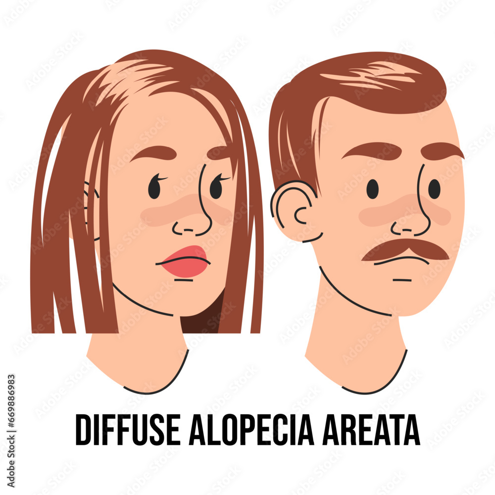 Diffuse alopecia areata vector isolated. Male and female character suffering from hair loss. Problems with health. Medical condition.