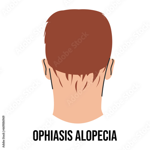 Ophiasis alopecia vector isolated. Male and female character suffering from hair loss. Problems with health. Medical condition.