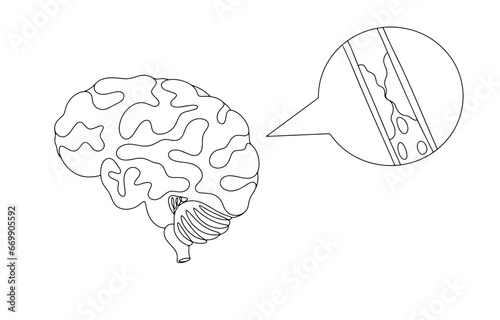 Ischemic stroke. One line