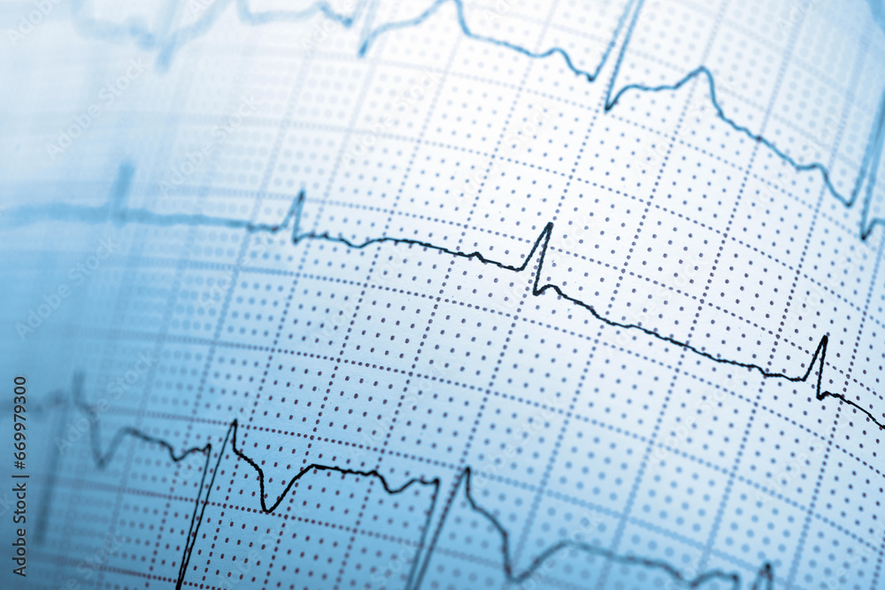 Close-up of an electrocardiogram printed on blue paper.