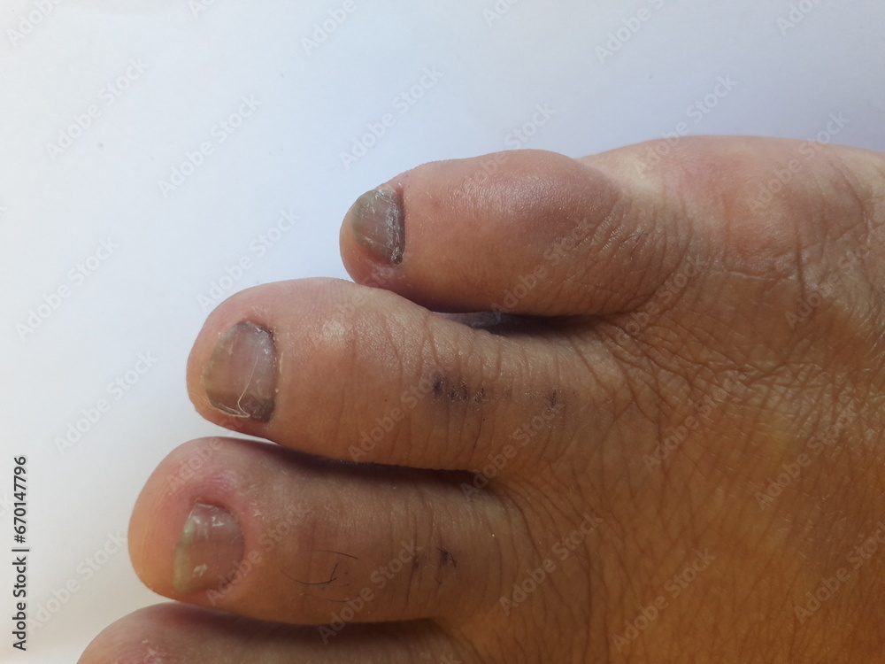 Unha do pé de pessoa com hipotireoidismo calosidades, micose, pele seca e desidratada Unha do pé de pessoa com hipotireoidismo calosidades, micose, pele seca e desidratada