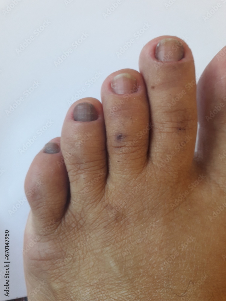 Unha do pé de pessoa com hipotireoidismo calosidades, micose, pele seca e desidratada Unha do pé de pessoa com hipotireoidismo calosidades, micose, pele seca e desidratada