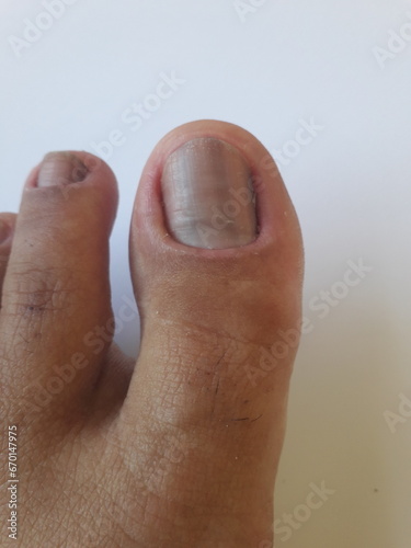 Unha do pé de pessoa com hipotireoidismo calosidades, micose, pele seca e desidratada photo