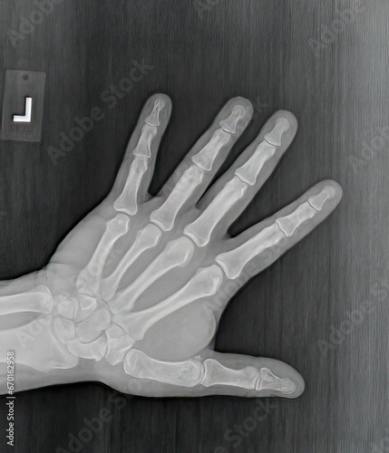 Film xray or radiograph of a normal left hand of an adult male. AP view show human's hand. normal bone structure of all phalanges carpal bones metacarpal, distal radius and ulna. joint space is normal photo