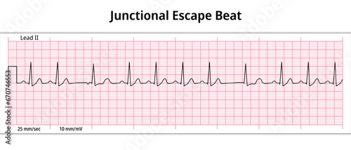 ECG Junctional Escape Beat - 8 Second ECG Paper - Electrocardiogram Vector Medical Illustration