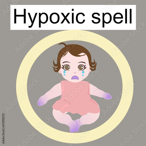 The sign of hypoxia spell or TOF spell there are the sign of central and peripheral cyanosis for medical and education information 
