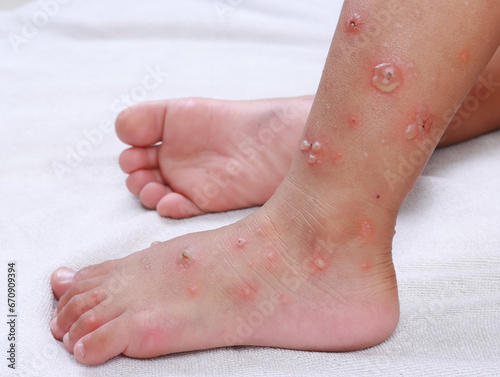 foot child asian Infection blister chicken pox dermatology measles medical allergic skin disease reaction red stickers  virus hfmd photo