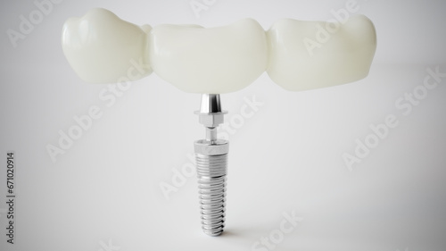 Dental Implant: Modern Solution for Tooth Replacement - 3D Rendering