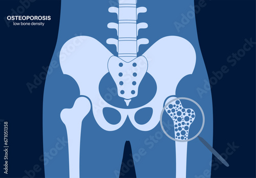 Osteoporosis medical poster