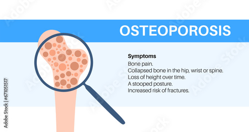 Osteoporosis medical poster