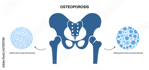 Osteoporosis medical poster