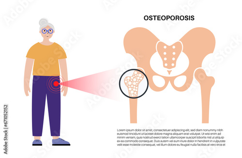 Osteoporosis medical poster