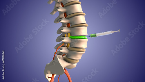 Injecting steroids to treat herniated disc pain	
 photo