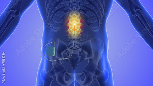 Spinal cord stimulation medical concept	 photo