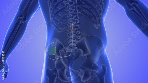 Spinal cord stimulation medical concept	