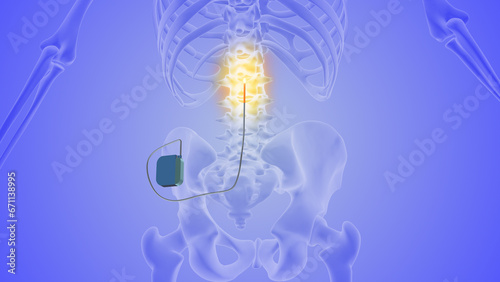 The medical notion of spinal cord stimulation	
 photo