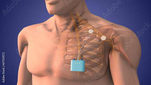 Peripheral nerve stimulation therapy in shoulder area	
