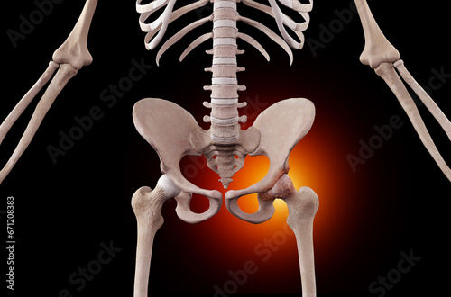 Skeleton with osteoarthritis hip joint injury