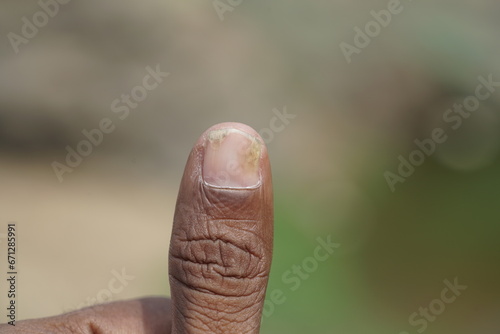 Nail psoriasis on thumb ,close up view,
 photo