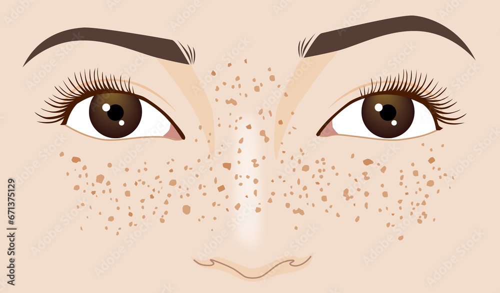 Freckle spot on caucasian woman's face, zoom in illustration