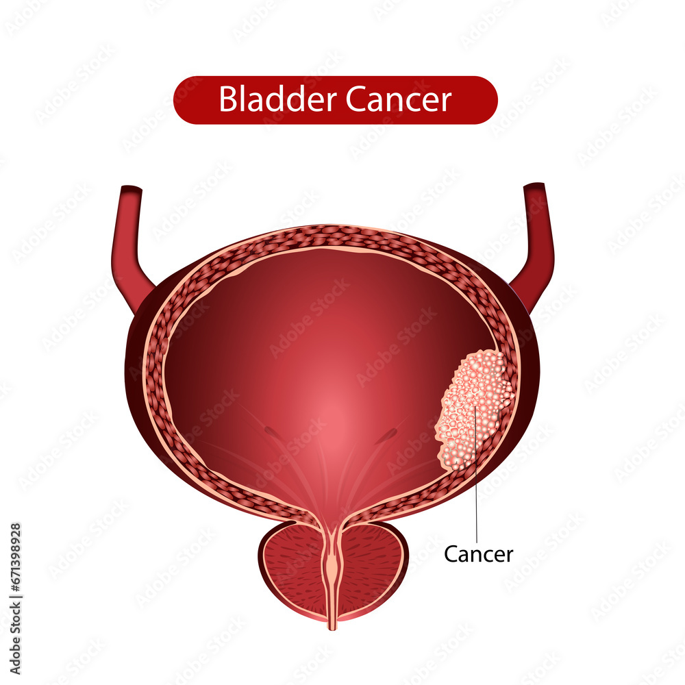 bladder illustration, bladder cancer, cancer cells, cancer anatomy