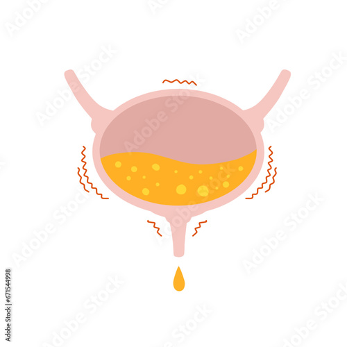 Overactive bladder. Urinal overflow. Stress signal, disorder and medical dysfunction of human body. Anatomical illustration isolated on white