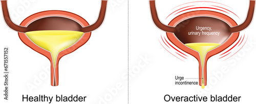 Overactive bladder. Loss of bladder control.