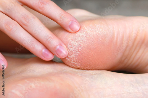 Close-up Dry skin on the heels of the feet photo