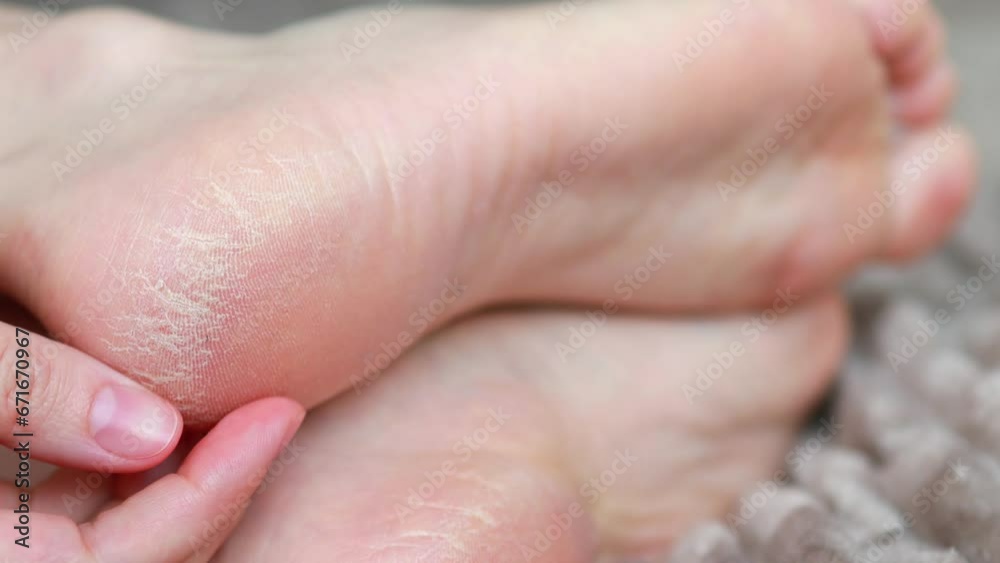 Close-up Dry skin on the heels of the feet Close-up Dry skin on the heels of the feet